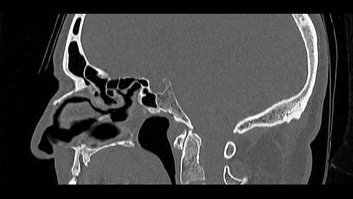 File:Arcuate foramen (Radiopaedia 89833-106944 Sagittal bone window 60).jpg
