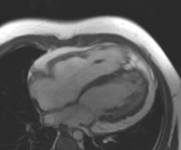 Arrhythmogenic right ventricular cardiomyopathy (Radiopaedia 69431-79307 4ch cine 43).jpg