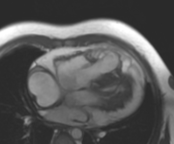 File:Arrhythmogenic right ventricular cardiomyopathy (Radiopaedia 69431-79307 4ch cine 69).jpg