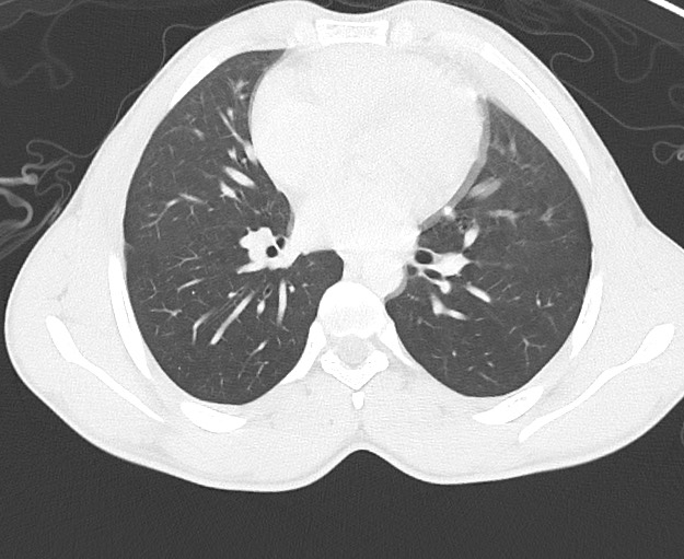 Arrow injury to the chest (Radiopaedia 75223-86321 Axial lung window 44).jpg