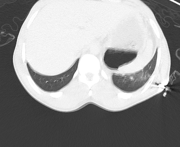 File:Arrow injury to the chest (Radiopaedia 75223-86321 Axial lung window 93).jpg