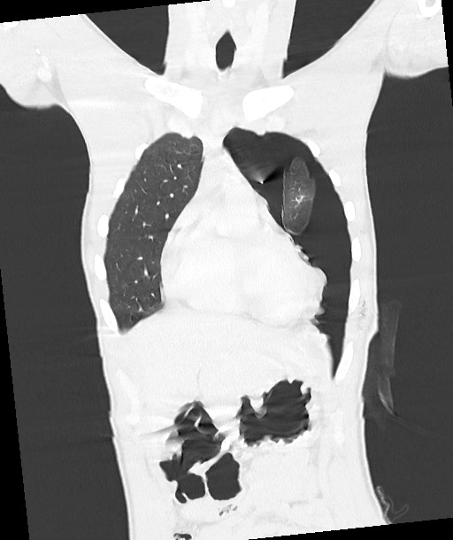 Arrow injury to the chest (Radiopaedia 85367-100975 Coronal lung window 54).jpg