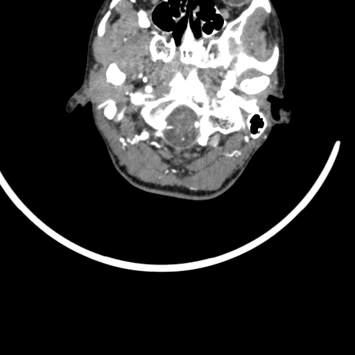 Arteriovenous malformation of the neck (Radiopaedia 53935-60062 A 65).jpg