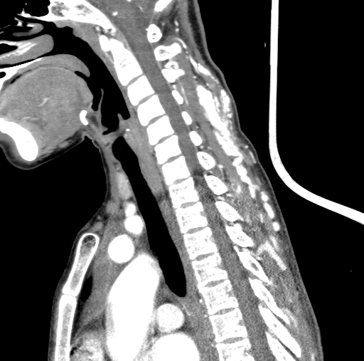 Arteriovenous malformation of the neck (Radiopaedia 53935-60062 C 62).jpg