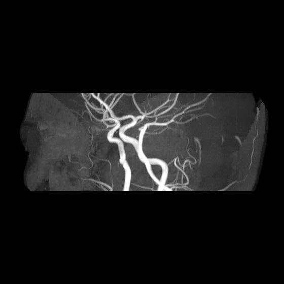 File:Artery of Percheron infarct (Radiopaedia 40966-43676 G 50).jpg