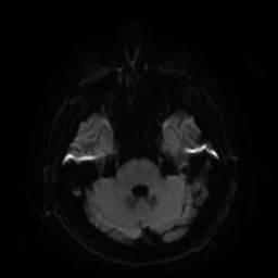 File:Artery of Percheron infarct (Radiopaedia 48088-52928 Axial DWI 10).jpg