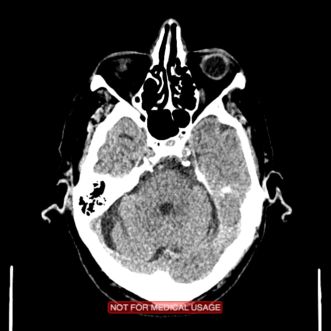 Artery of Percheron infarction (Radiopaedia 28679-28967 Axial non-contrast 34).jpg
