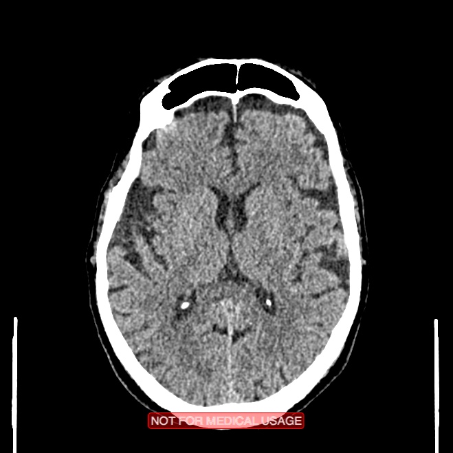Artery of Percheron infarction (Radiopaedia 28679-28967 Axial non-contrast 64).jpg