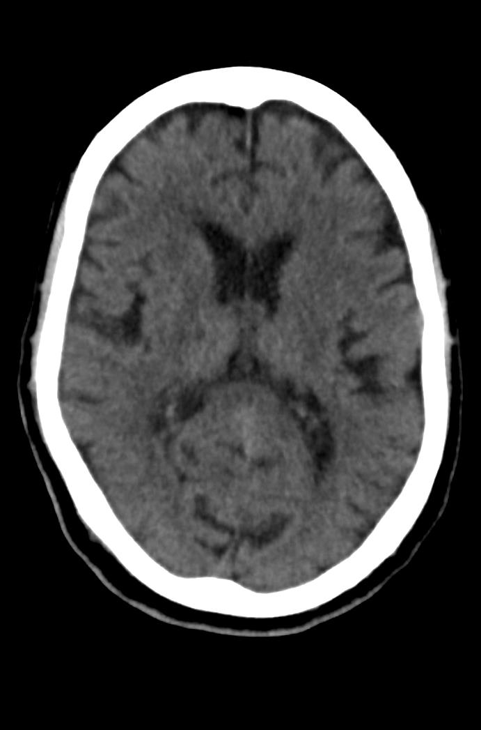 Artery of Percheron infarction (Radiopaedia 80613-94202 Axial non-contrast 107).jpg
