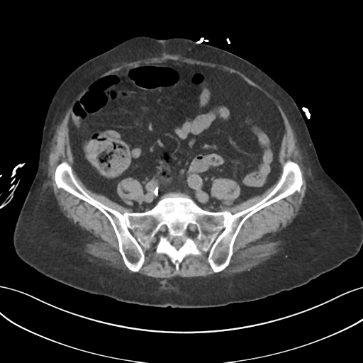 File:Ascending cholangitis (Radiopaedia 39068-41253 Axial non-contrast 45).png