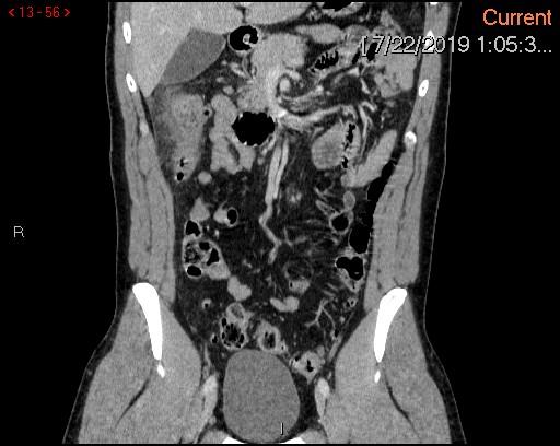 File:Ascending colonic diverticulum mimicking acute appendicitis (Radiopaedia 69943-80198 B 56).jpg