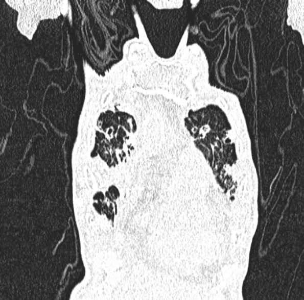 Aspergilloma- with Monod sign (Radiopaedia 44737-48532 Coronal lung window 137).jpg