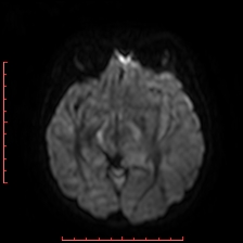 Astroblastoma (Radiopaedia 74287-85162 Axial DWI 43).jpg