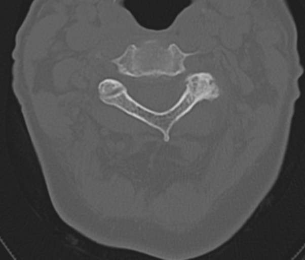 Atlanto-axial subluxation (Radiopaedia 36610-38176 Axial bone window 22).png