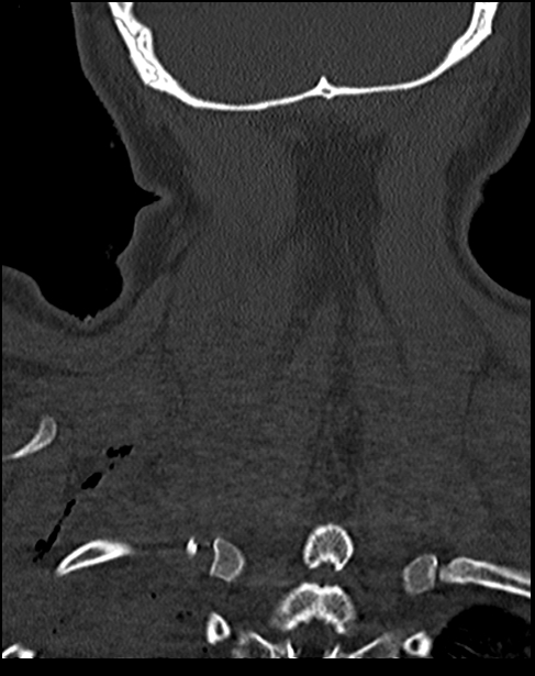 Atlanto-occipital dissociation - Traynelis type 1 (Radiopaedia 87570-103948 Coronal bone window 50).jpg