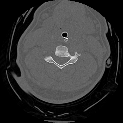 Atlanto-occipital dissociation injury (Radiopaedia 29274-29698 Axial bone window 41).png