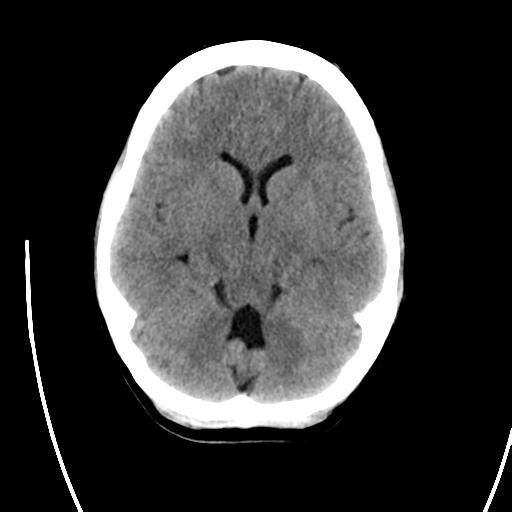 File:Atretic encephalocoele with inferior vermis hypoplasia (Radiopaedia 30443-31107 A 10).jpg