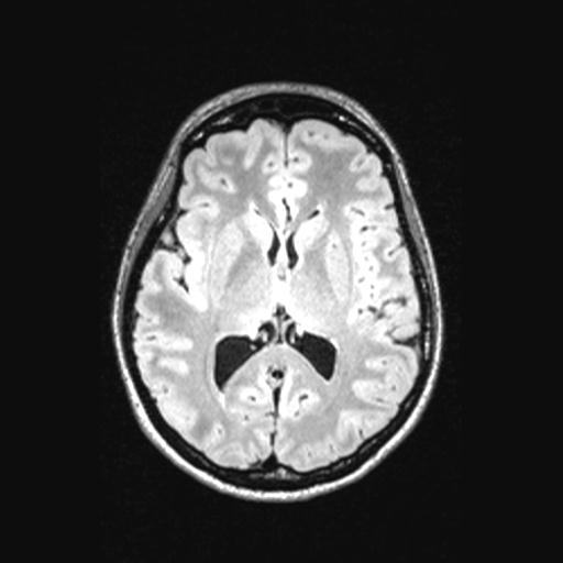 Atretic encephalocoele with inferior vermis hypoplasia (Radiopaedia 30443-31108 Axial 86).jpg