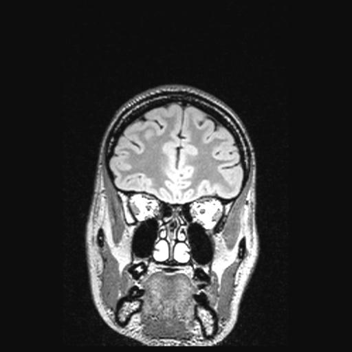 File:Atretic encephalocoele with inferior vermis hypoplasia (Radiopaedia 30443-31108 Coronal FLAIR 142).jpg
