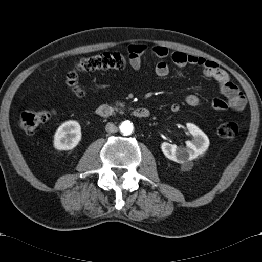 Atypical hepatocellular carcinoma (Radiopaedia 41744-44698 A 56).jpg