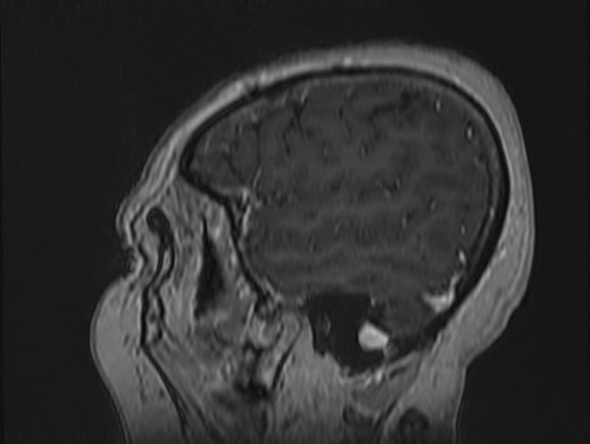 Atypical meningioma (Radiopaedia 62985-71406 Sagittal T1 C+ 9).jpg