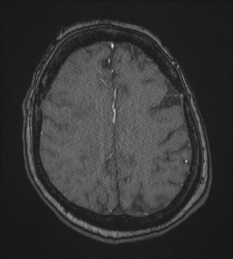 Atypical meningioma (WHO Grade II) (Radiopaedia 54742-60981 Axial MRA 73).png