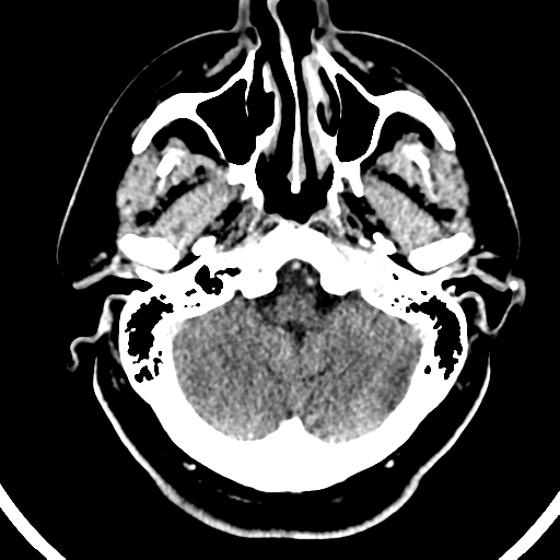 Atypical meningioma (WHO grade II) with brain invasion (Radiopaedia 57767-64728 Axial C+ 47).png