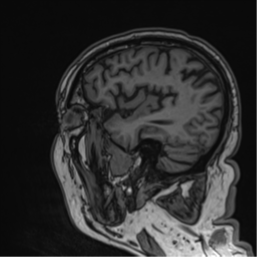 Atypical meningioma (WHO grade II) with brain invasion (Radiopaedia 57767-64729 Sagittal T1 22).png