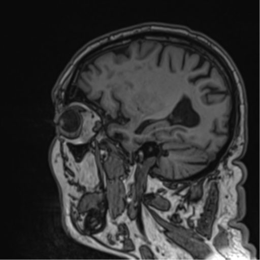 File:Atypical meningioma (WHO grade II) with brain invasion (Radiopaedia 57767-64729 Sagittal T1 25).png