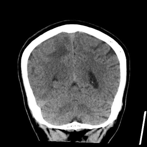 Atypical meningioma (WHO grade II) with osseous invasion (Radiopaedia 53654-59715 Coronal non-contrast 47).png