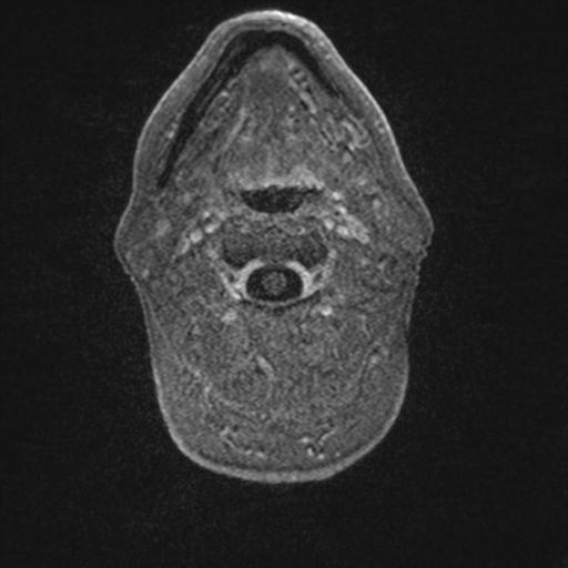 Atypical meningioma (grade II) - en plaque (Radiopaedia 29633-30147 Axial T1 C+ 5).jpg