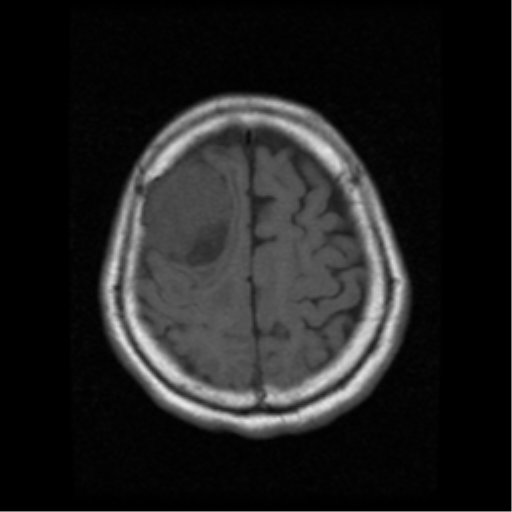 File:Atypical meningioma with skull invasion (Radiopaedia 34357-35648 Axial T1 18).png