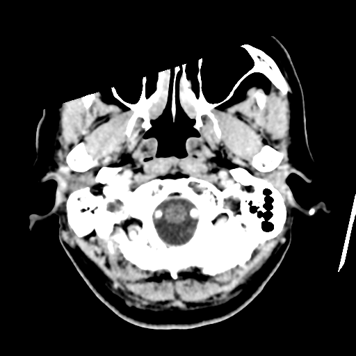 Atypical meningioma with skull invasion (Radiopaedia 34357-35649 Axial C+ delayed 7).png