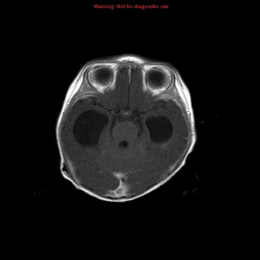 File:Atypical teratoid rhabdoid tumor (Radiopaedia 10712-11183 Axial T1 C+ 12).jpg