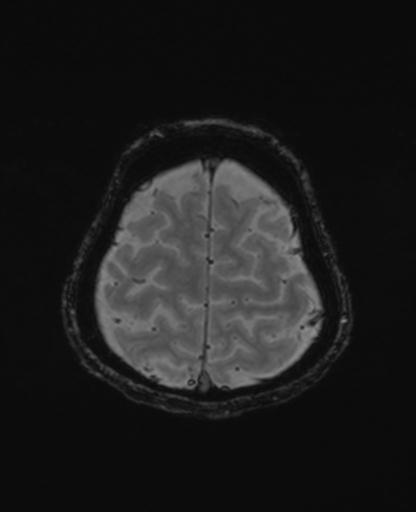 Autoimmune limbic encephalitis (Radiopaedia 30363-31005 SWI - magnitude 69).jpg