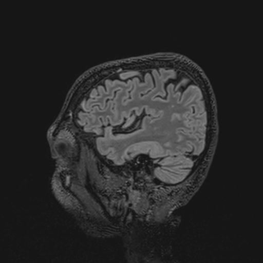 Autoimmune limbic encephalitis (Radiopaedia 30363-31005 Sagittal FLAIR 121).jpg