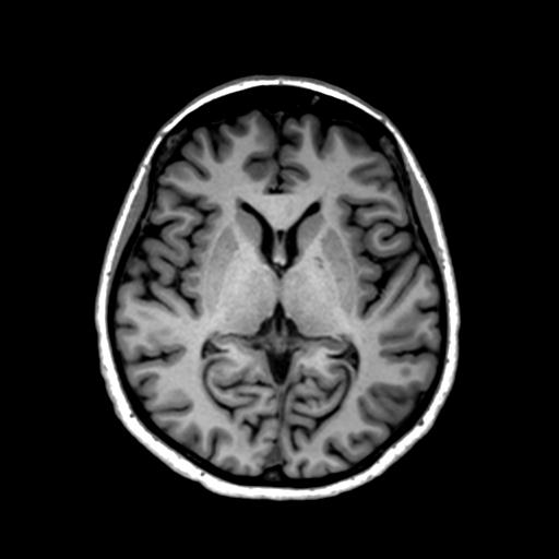 File:Autoimmune limbic encephalitis (Radiopaedia 30363-31005 T1 Axial 1mm 80).jpg