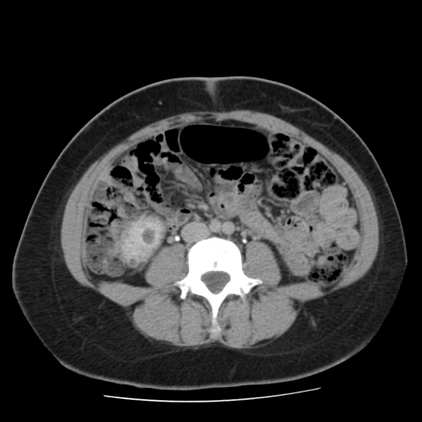 Autosomal dominant polycystic kidney disease (Radiopaedia 23061-23093 C+ delayed 42).jpg