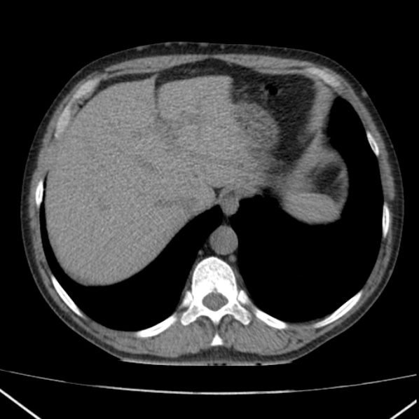 File:Autosomal dominant polycystic kidney disease (Radiopaedia 36539-38101 Axial non-contrast 13).jpg