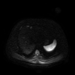 Autosomal dominant polycystic kidney disease (Radiopaedia 50259-55611 Axial DWI 79).jpg