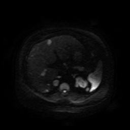 Autosomal dominant polycystic kidney disease (Radiopaedia 50259-55611 Axial DWI 86).jpg
