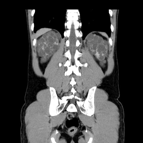 Autosomal dominant polycystic kidney disease (Radiopaedia 66349-75582 A 74).jpg