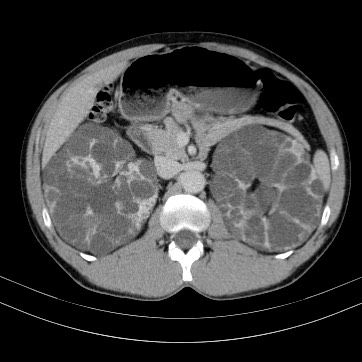 Autosomal dominant polycystic kidney disease (Radiopaedia 66349-75582 B 34).jpg