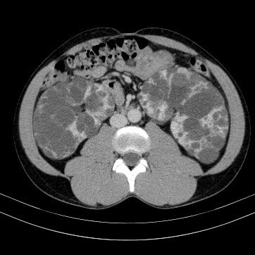 Autosomal dominant polycystic kidney disease (Radiopaedia 66349-75582 B 53).jpg