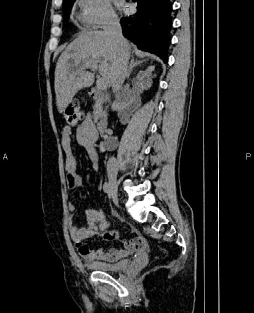 Autosomal dominant polycystic kidney disease (Radiopaedia 87830-104287 C 37).jpg