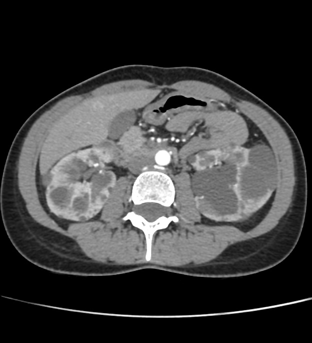 Autosomal dominant polycystic kidney disease - early onset (Radiopaedia 40734-43387 B 30).jpg