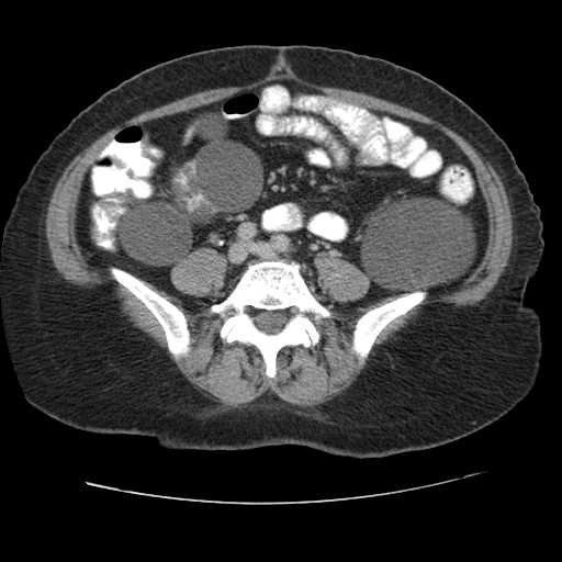 Autosomal dominant polycystic kidney disease with hepatic involvement (Radiopaedia 32693-33662 C 54).jpg