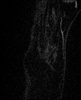 Avascular necrosis of the capitate (Radiopaedia 88317-104948 Coronal T1 vibe 4).jpg