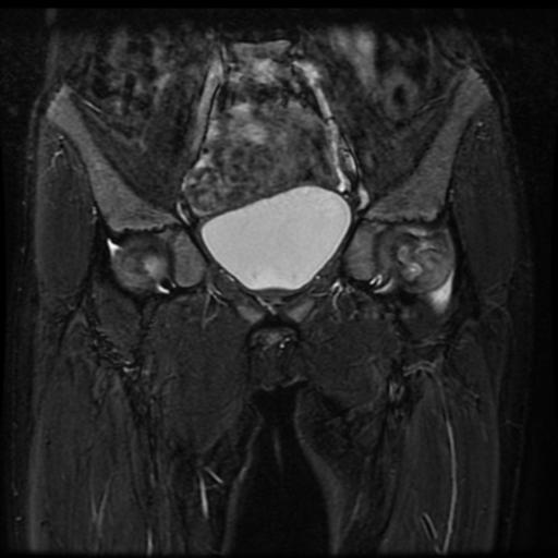 File:Avascular necrosis of the hip (Radiopaedia 29563-30067 Coronal T2 fat sat 4).jpg