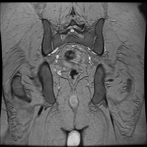 Avascular necrosis of the hip (Radiopaedia 61503-69465 F 79).jpg